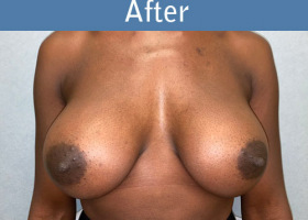 Milwaukee Plastic Surgery - Breast Augmentation - 30-2