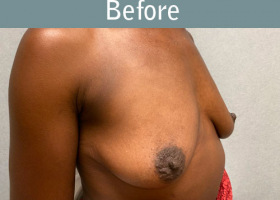Milwaukee Plastic Surgery - Breast Augmentation - 30-3