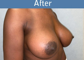 Milwaukee Plastic Surgery - Breast Augmentation - 30-4