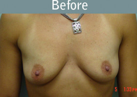 Milwaukee Plastic Surgery - Breast Augmentation - 4-1