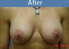 Milwaukee Plastic Surgery - Breast Augmentation - 4-2