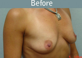 Milwaukee Plastic Surgery - Breast Augmentation - 5-1