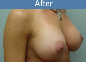 Milwaukee Plastic Surgery - Breast Augmentation - 5-2