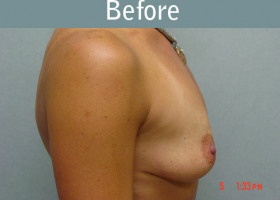 Milwaukee Plastic Surgery - Breast Augmentation - 6-1