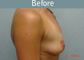 Milwaukee Plastic Surgery - Breast Augmentation - 6-1