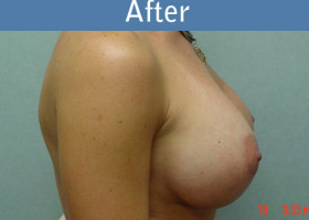 Milwaukee Plastic Surgery - Breast Augmentation - 6-2