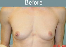 Milwaukee Plastic Surgery - Breast Augmentation - 7-1