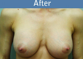 Milwaukee Plastic Surgery - Breast Augmentation - 7-2