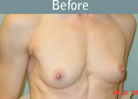 Milwaukee Plastic Surgery - Breast Augmentation - 8-1