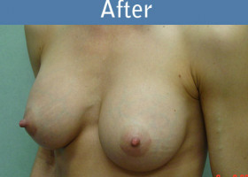 Milwaukee Plastic Surgery - Breast Augmentation - 8-2