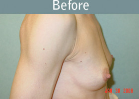 Milwaukee Plastic Surgery - Breast Augmentation - 9-1