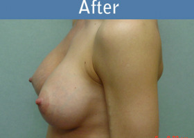 Milwaukee Plastic Surgery - Breast Augmentation - 9-2