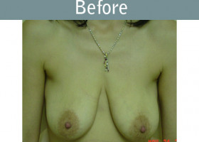 Milwaukee Plastic Surgery - Breast Lift - 01-1