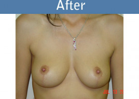 Milwaukee Plastic Surgery - Breast Lift - 01-2