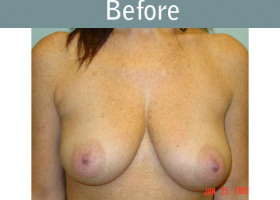 Milwaukee Plastic Surgery - Breast Lift - 10-1