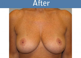 Milwaukee Plastic Surgery - Breast Lift - 10-2