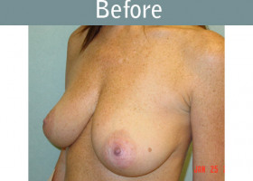Milwaukee Plastic Surgery - Breast Lift - 11-1