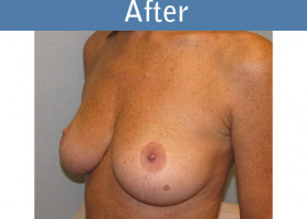 Milwaukee Plastic Surgery - Breast Lift - 11-2