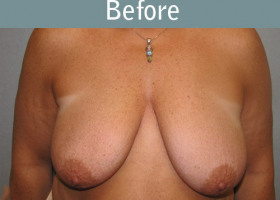 Milwaukee Plastic Surgery - Breast Lift - 12-1