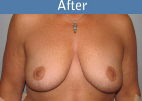 Milwaukee Plastic Surgery - Breast Lift - 12-2