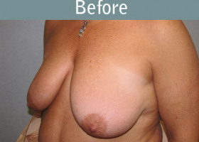 Milwaukee Plastic Surgery - Breast Lift - 13-1