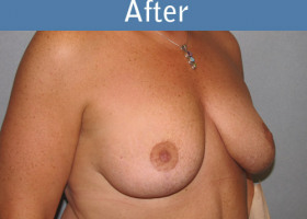 Milwaukee Plastic Surgery - Breast Lift - 13-2