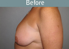 Milwaukee Plastic Surgery - Breast Lift - 14-1