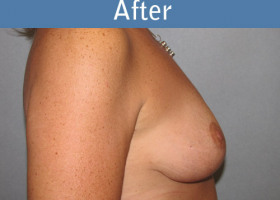 Milwaukee Plastic Surgery - Breast Lift - 14-2