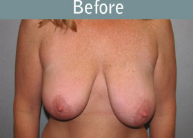 Milwaukee Plastic Surgery - Breast Lift - 15-1