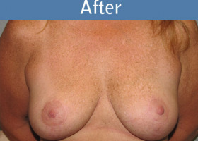 Milwaukee Plastic Surgery - Breast Lift - 15-2