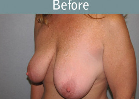 Milwaukee Plastic Surgery - Breast Lift - 16-1