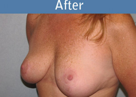 Milwaukee Plastic Surgery - Breast Lift - 16-2