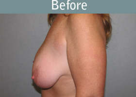 Milwaukee Plastic Surgery - Breast Lift - 17-1