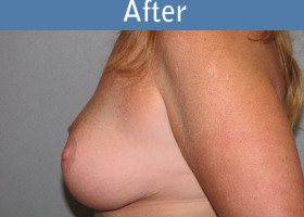 Milwaukee Plastic Surgery - Breast Lift - 17-2