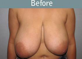 Milwaukee Plastic Surgery - Breast Lift - 18-1