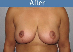 Milwaukee Plastic Surgery - Breast Lift - 18-2