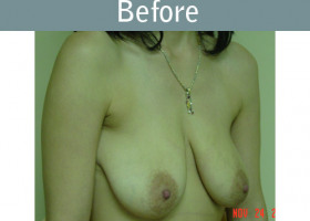 Milwaukee Plastic Surgery - Breast Lift - 02-1