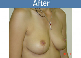 Milwaukee Plastic Surgery - Breast Lift - 02-2