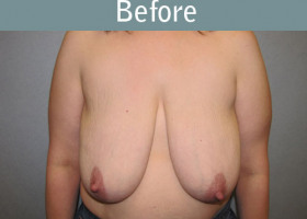 Milwaukee Plastic Surgery - Breast Lift - 20-1