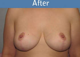 Milwaukee Plastic Surgery - Breast Lift - 20-2