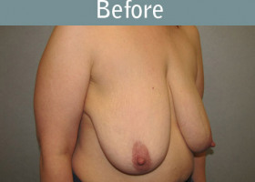 Milwaukee Plastic Surgery - Breast Lift - 20-3