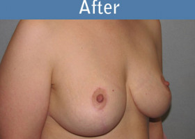 Milwaukee Plastic Surgery - Breast Lift - 20-4