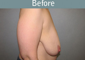 Milwaukee Plastic Surgery - Breast Lift - 20-5