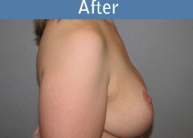 Milwaukee Plastic Surgery - Breast Lift - 20-6
