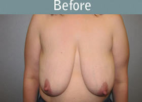 Milwaukee Plastic Surgery - Breast Lift - 21-1