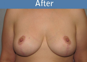 Milwaukee Plastic Surgery - Breast Lift - 21-2