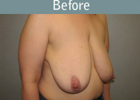 Milwaukee Plastic Surgery - Breast Lift - 21-3