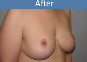 Milwaukee Plastic Surgery - Breast Lift - 21-4