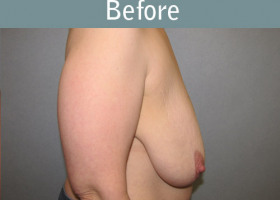 Milwaukee Plastic Surgery - Breast Lift - 21-5