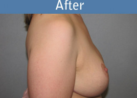 Milwaukee Plastic Surgery - Breast Lift - 21-6